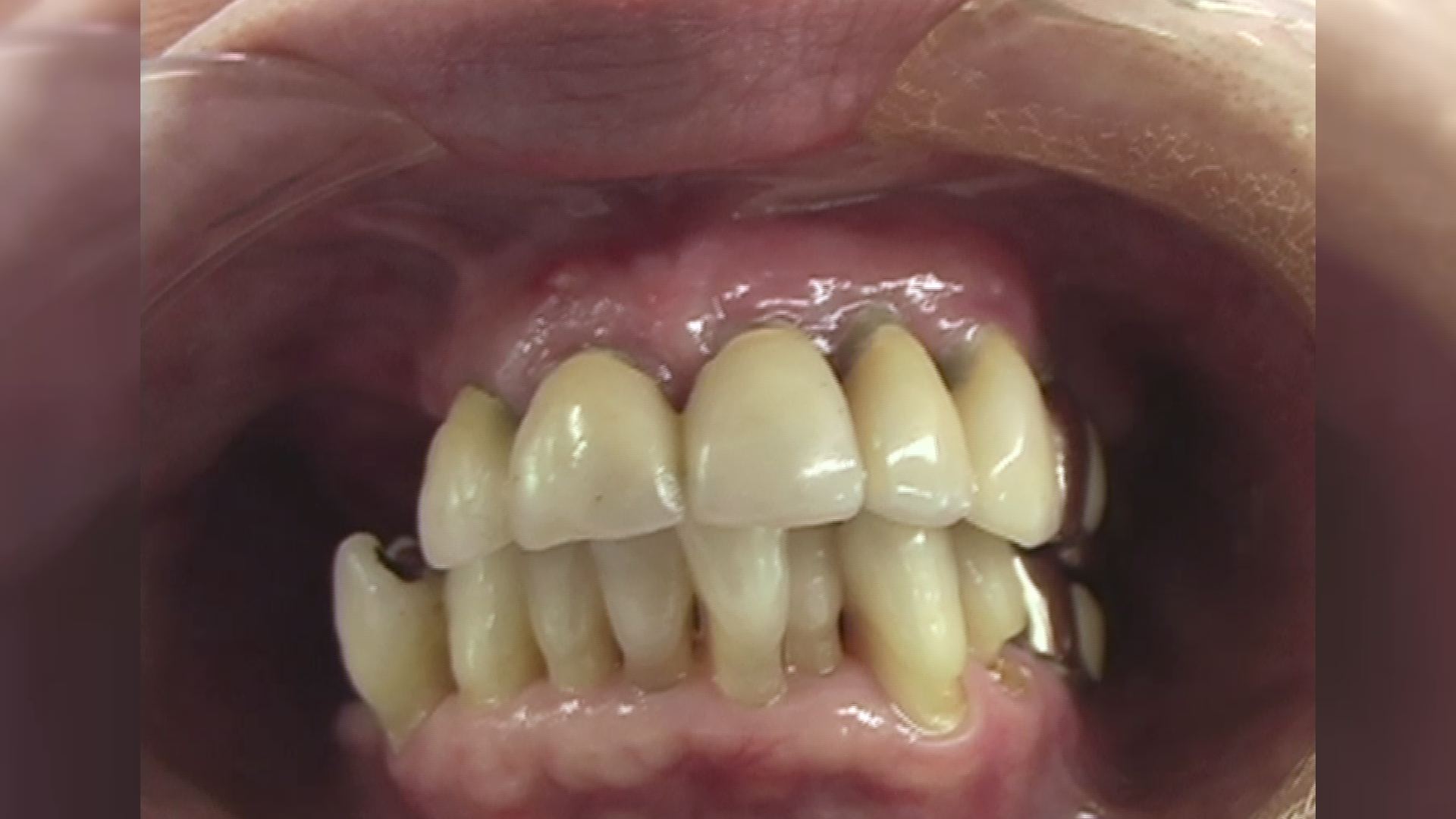 リテーナー義歯の臨床