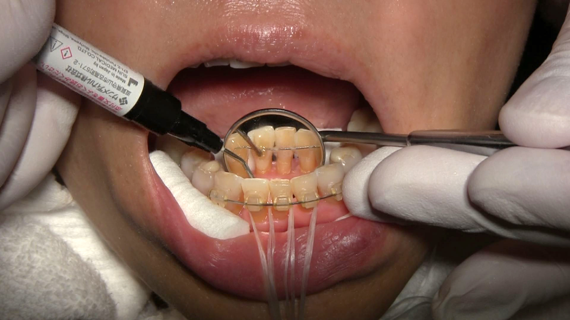 成人歯科矯正治療のベーシックテクニック
