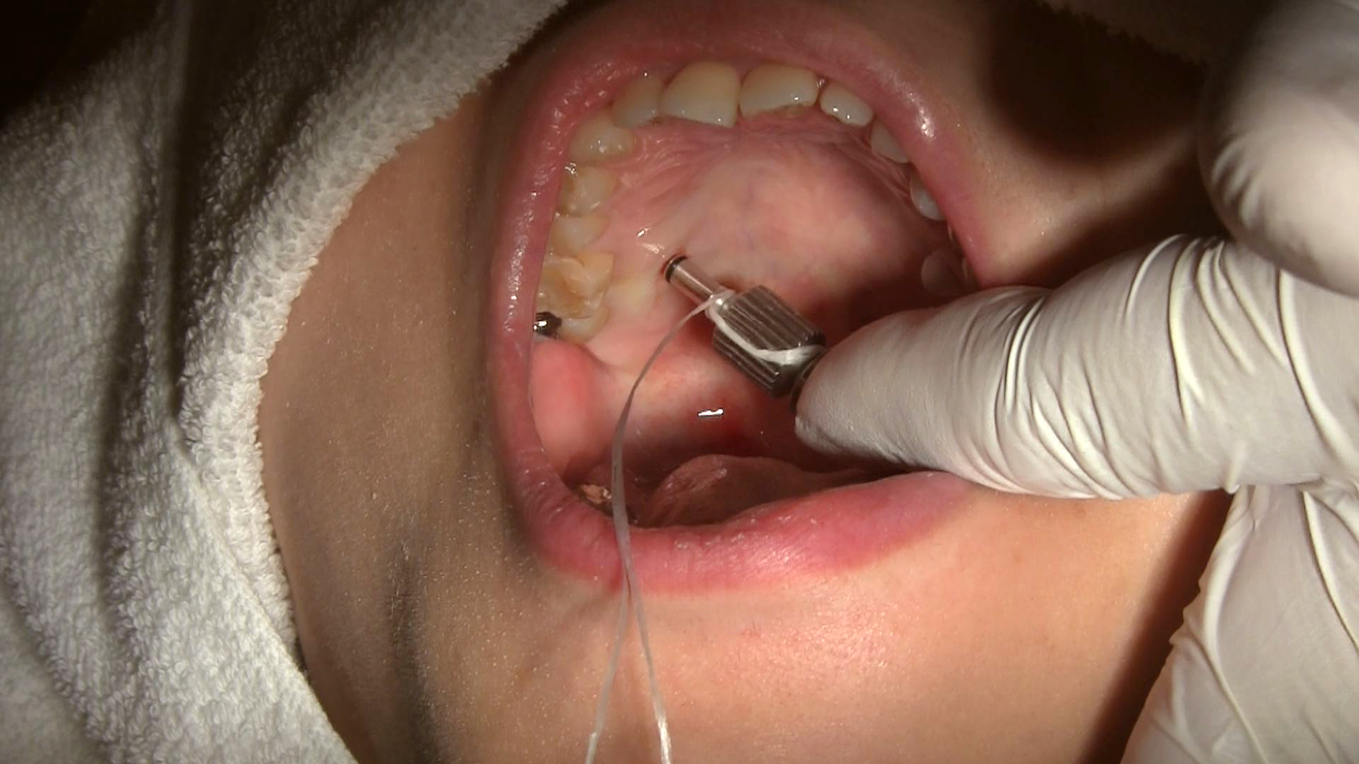 成人歯科矯正治療のベーシックテクニック