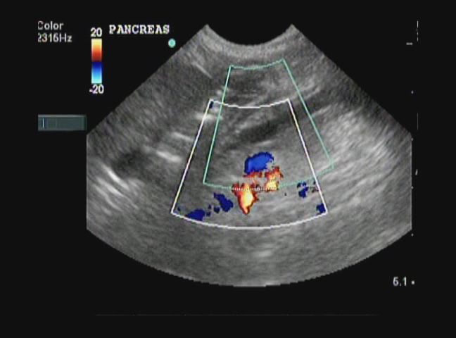 超音波を用いた胃と膵臓の検査