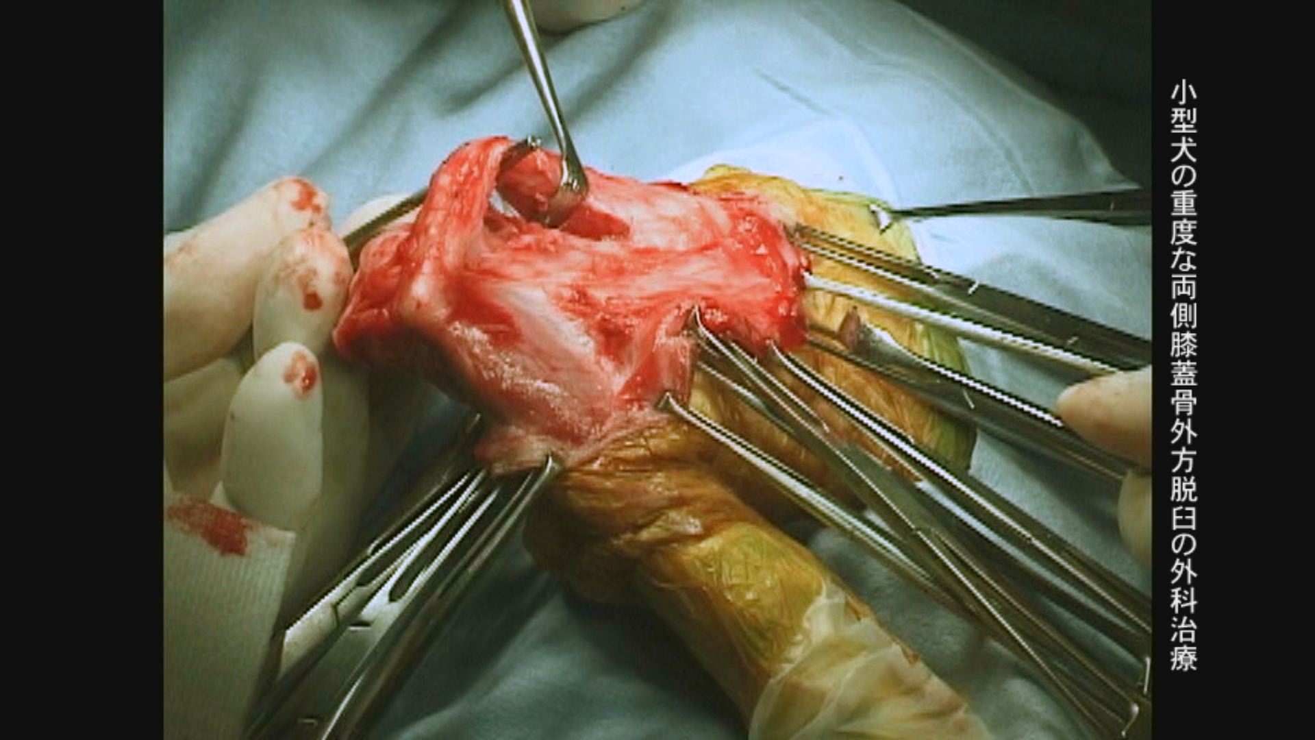 膝蓋骨脱臼の外科治療