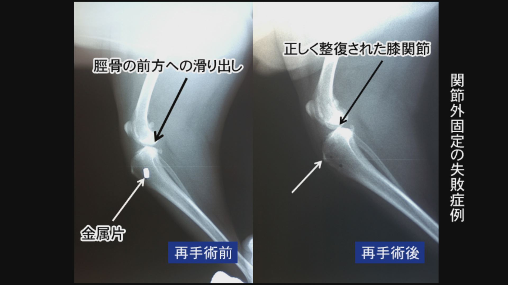 前十字靭帯断裂の外科治療