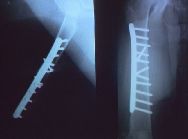 イヌの大腿骨骨折の内固定法