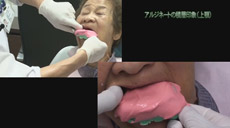 高精度全部床義歯03