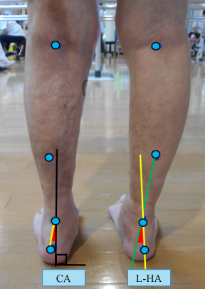 後足部の評価